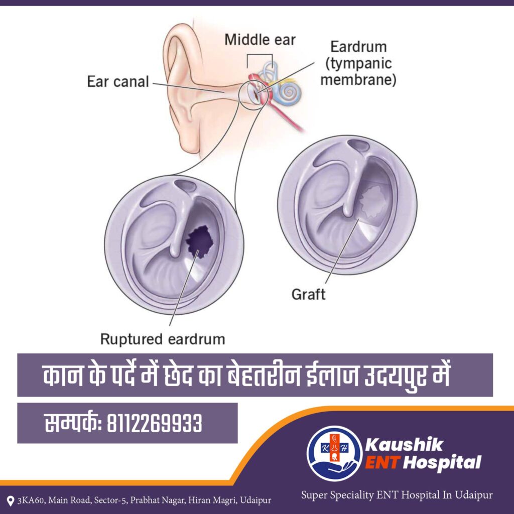 tympanoplasty-surgery-udaipur-1024×1024